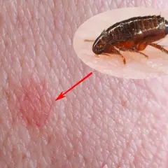 Gros plan d'une piqûre de puce de chien sur la peau humaine, avec une puce agrandie pointée par une flèche rouge.